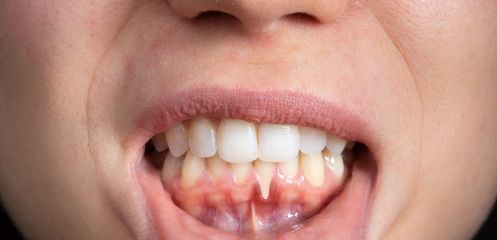 Receding gums